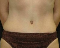 After tummy tuck front view female patient case 2774