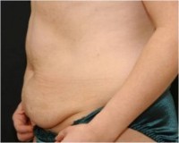 Before tummy tuck left side view female patient case 2774