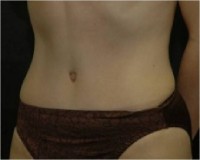 After tummy tuck left angle view female patient case 2774