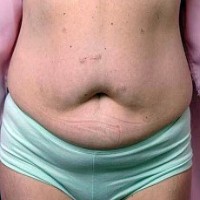 Before tummy tuck front view female patient case 2799