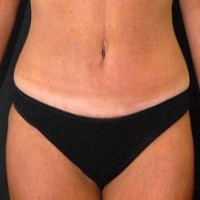 After tummy tuck front view female patient case 2799