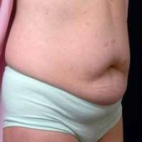 Before tummy tuck right angle view female patient case 2799
