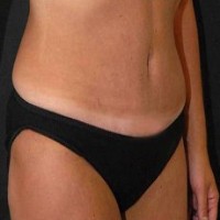 After tummy tuck right angle view female patient case 2799