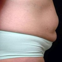 Before tummy tuck right side view female patient case 2799
