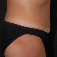 After tummy tuck right side view female patient case 2799