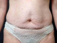 Before tummy tuck front view female patient case 2808