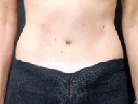 After tummy tuck front view female patient case 2808