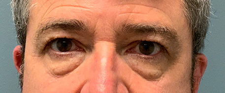 before eyelid surgery front view male patient case 3554