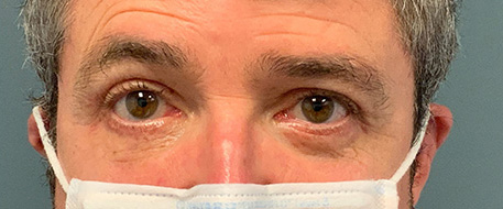 after eyelid surgery front view male patient case 3554