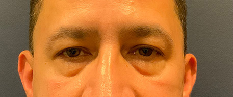 before eyelid surgery front view male patient case 4069