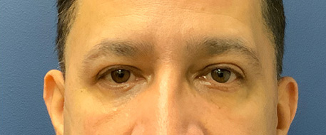 after eyelid surgery front view male patient case 4069