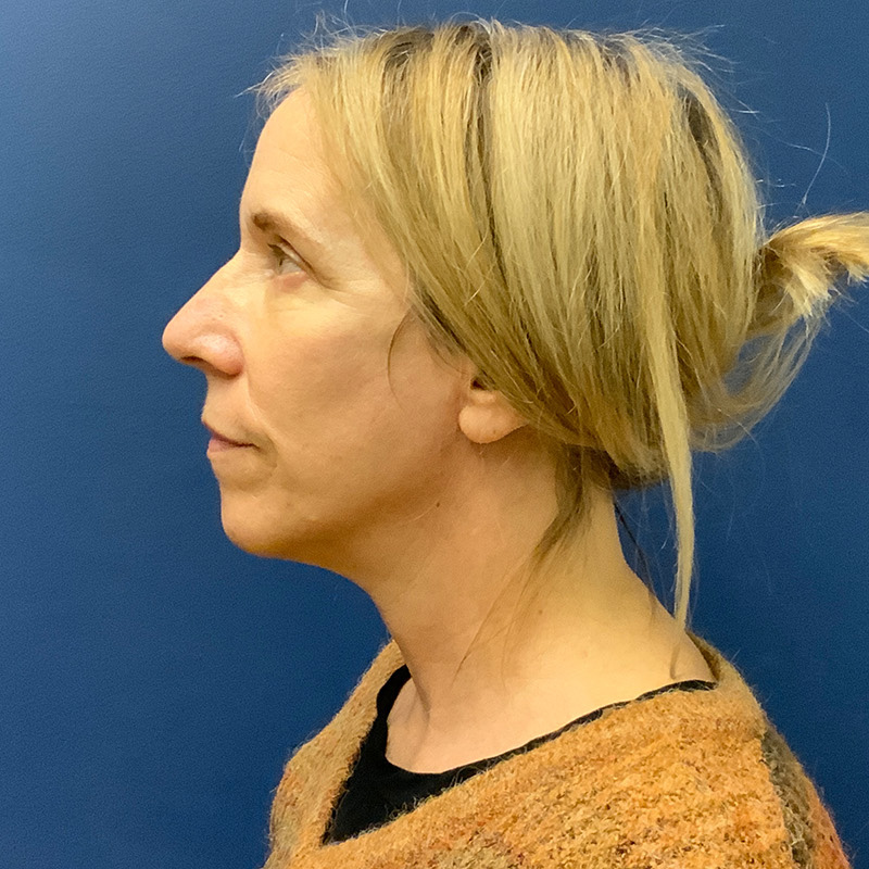 after facelift left side view female patient case 4105