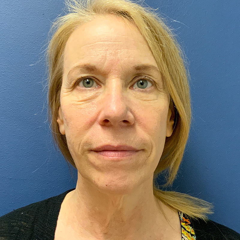 before facelift front view female patient case 4105