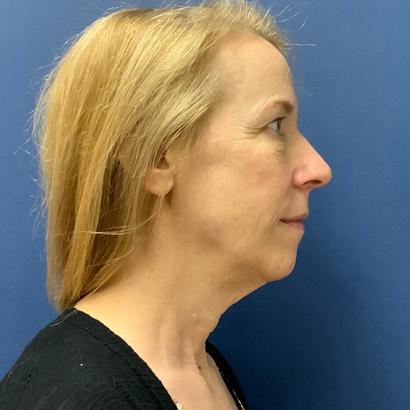 before facelift right side view female patient case 4105