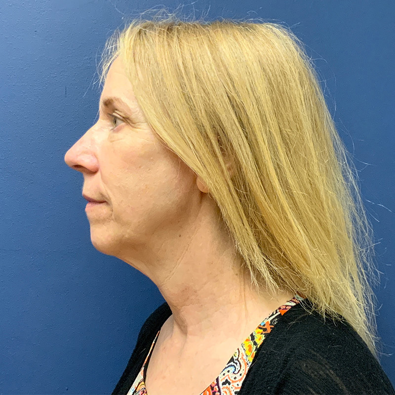 before facelift left side view female patient case 4105