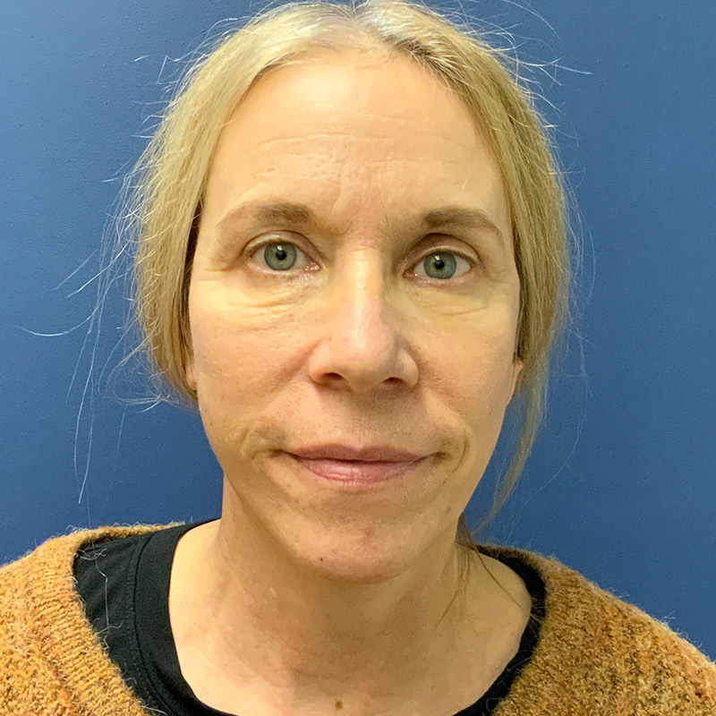 after facelift front view female patient case 4105