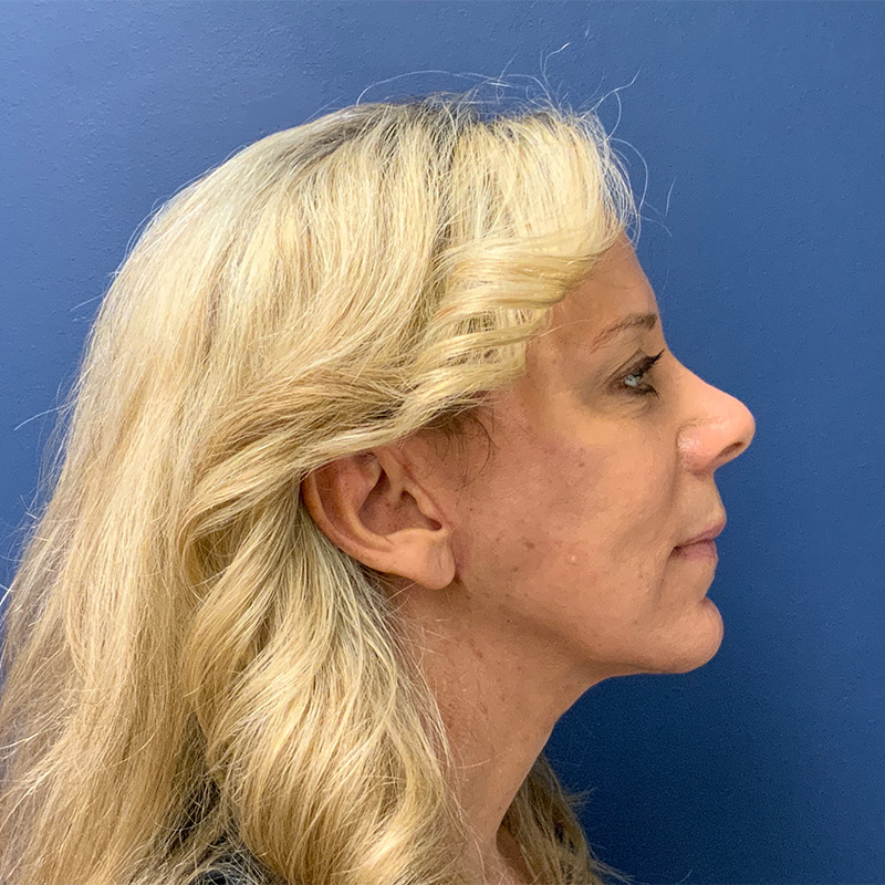after facelift right side view female patient case 4112