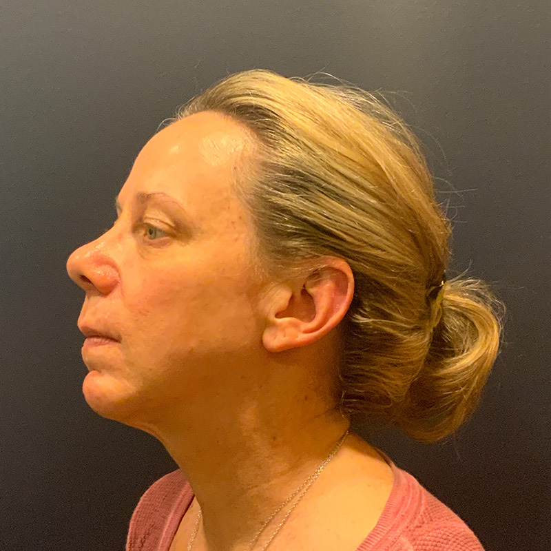 before facelift left side view female patient case 4112