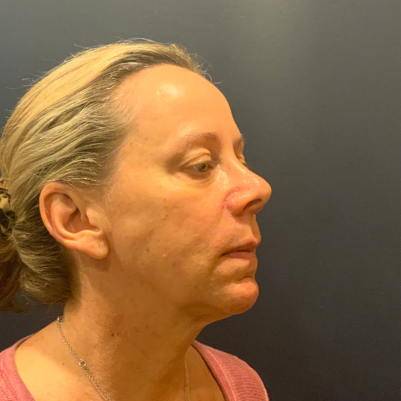 before facelift right angle view female patient case 4112