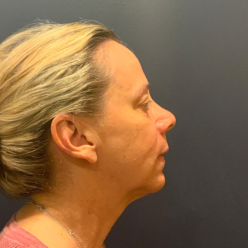 before facelift right side view female patient case 4112