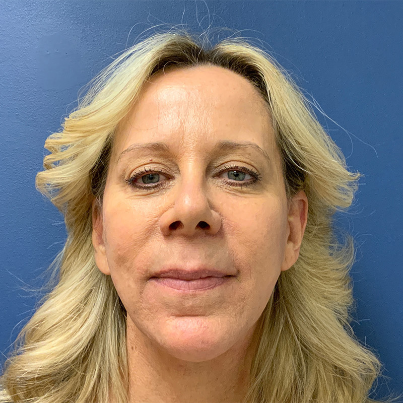 after facelift front view female patient case 4112