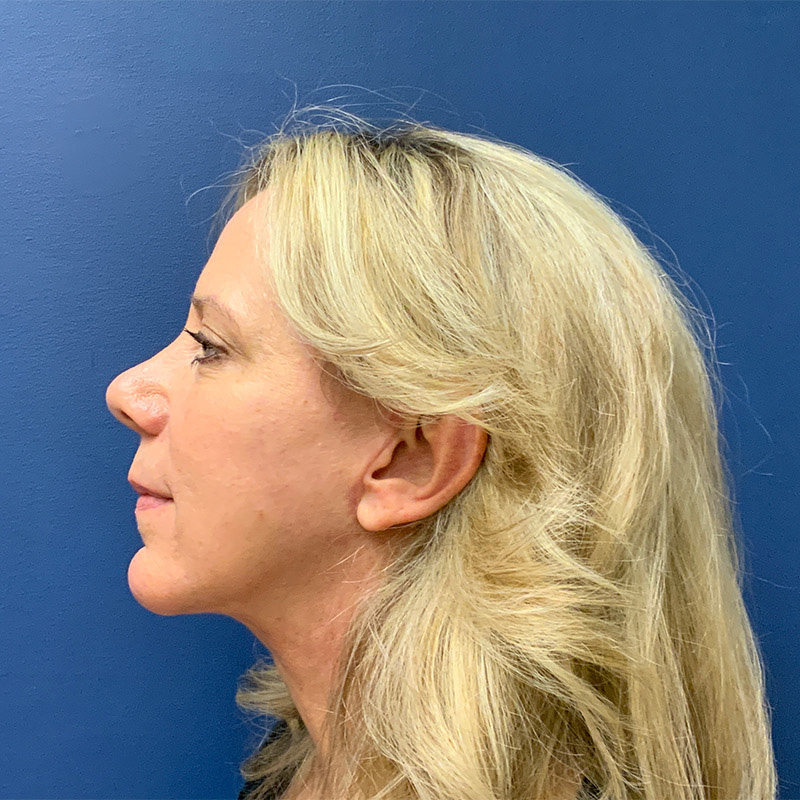 after facelift left side view female patient case 4112