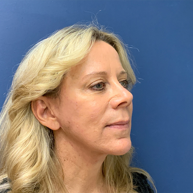 after facelift right angle view female patient case 4112