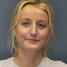 before rhinoplasty front view female patient case 4407