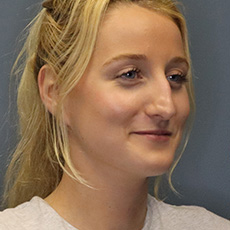 before rhinoplasty right angle view female patient case 4407