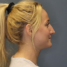 before rhinoplasty right side view female patient case 4407