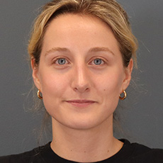 after rhinoplasty front view female patient case 4407