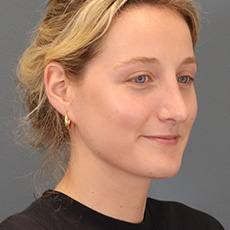 after rhinoplasty right angle view female patient case 4407