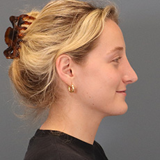 after rhinoplasty right side view female patient case 4407