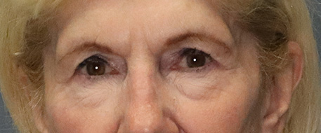 before eyelid surgery front view female patient case 4713