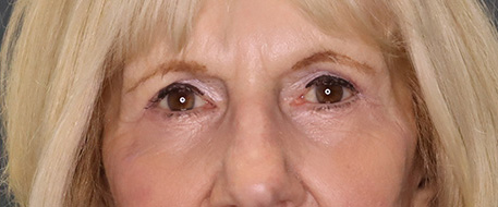 after eyelid surgery front view female patient case 4713