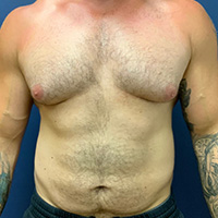 before gynecomastia front view male patient case 5002