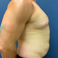 before gynecomastia right side view male patient case 5002