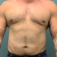 after gynecomastia front view male patient case 5002