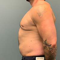 after gynecomastia left side view male patient case 5002
