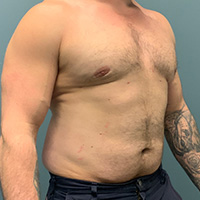 after gynecomastia right angle view male patient case 5002