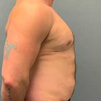 after gynecomastia right side view male patient case 5002