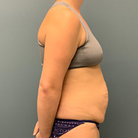 before tummy tuck right side view female patient case 4946