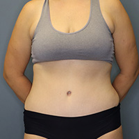 after tummy tuck front view female patient case 4946