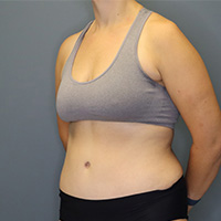after tummy tuck left angle view female patient case 4946