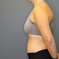 after tummy tuck left side view female patient case 4946