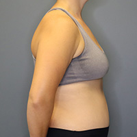 after tummy tuck right side view female patient case 4946