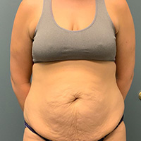 before tummy tuck front view female patient case 4946