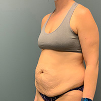 before tummy tuck left angle view female patient case 4946