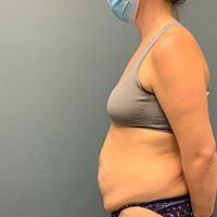 before tummy tuck left side view female patient case 4946