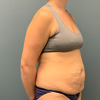 before tummy tuck right angle view female patient case 4946